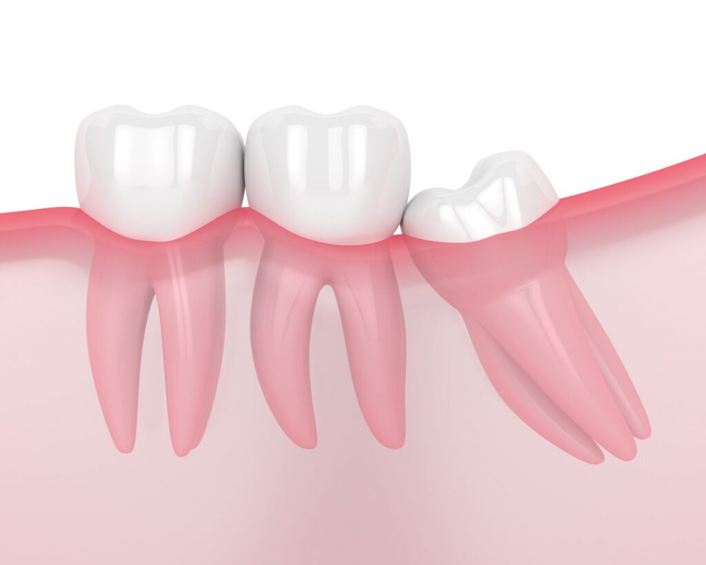 What to expect when having wisdom teeth removed