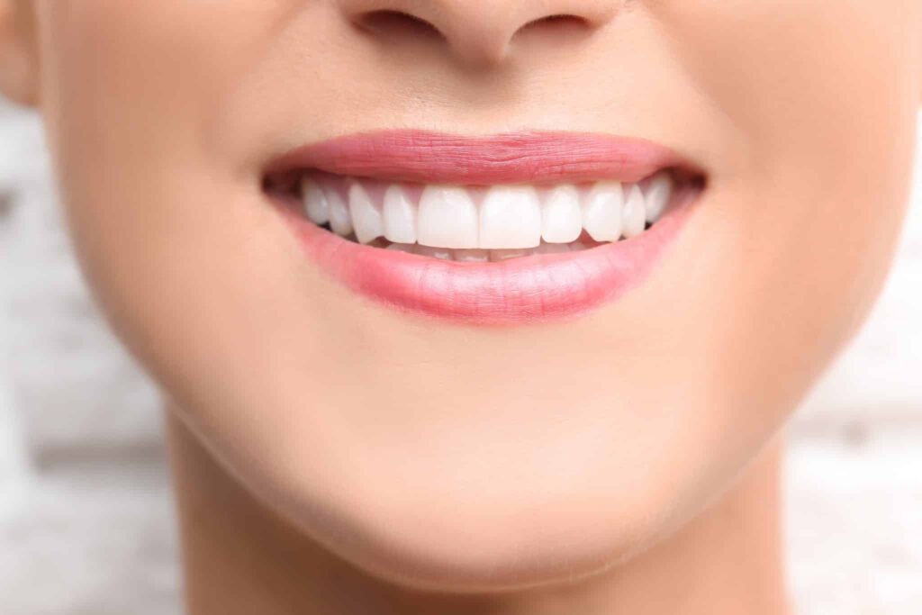 Teeth Bonding: What You Need to Know