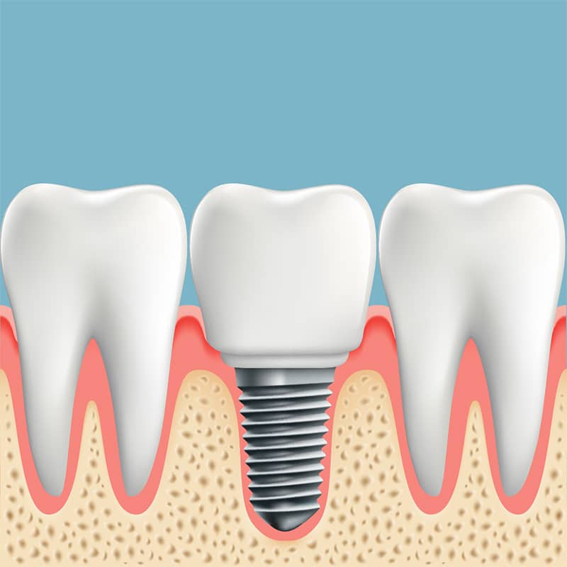 Your Intro to Dental Implants