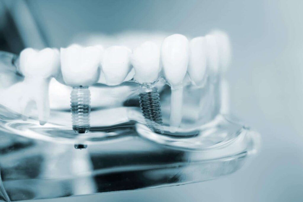 Understanding the Implant Placement Process