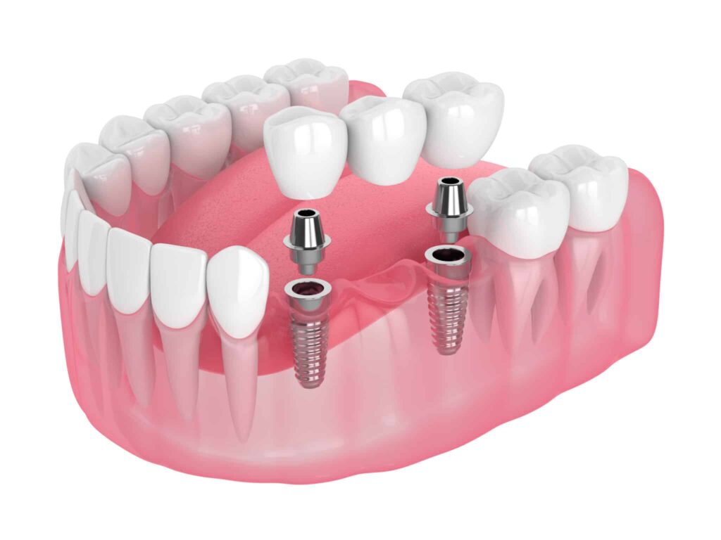 Highlighting the Advantages of Implant-Supported Bridges Compared to Traditional Dental Bridges