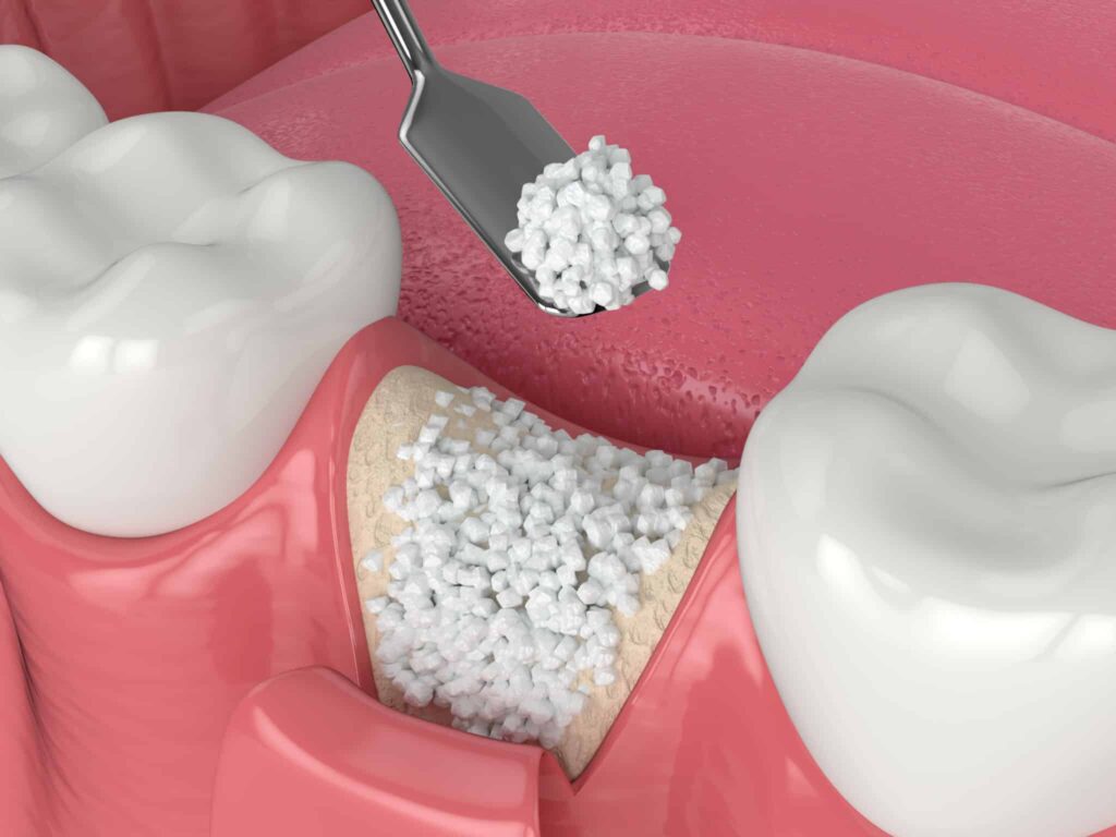 The Role of Bone Grafting in Treating Periodontal Disease in Murrieta