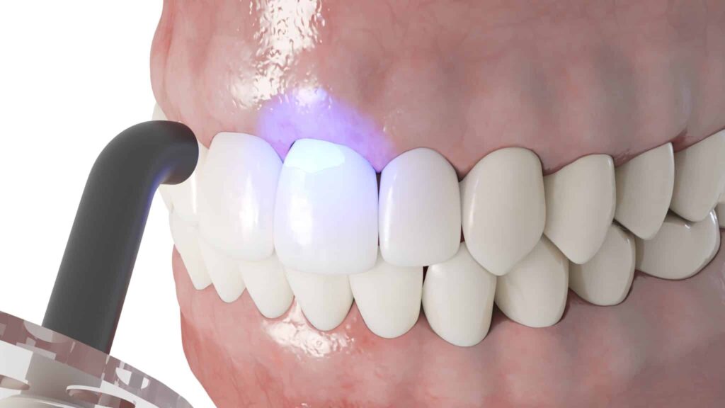 Tooth Bonding for Misaligned Teeth: A Non-Invasive Option