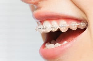 Clear Braces Treatment In Murrieta