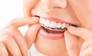 invisalign-in-murrieta