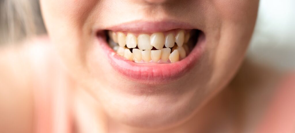 Can Cosmetic Dentistry Fix Crooked Teeth?