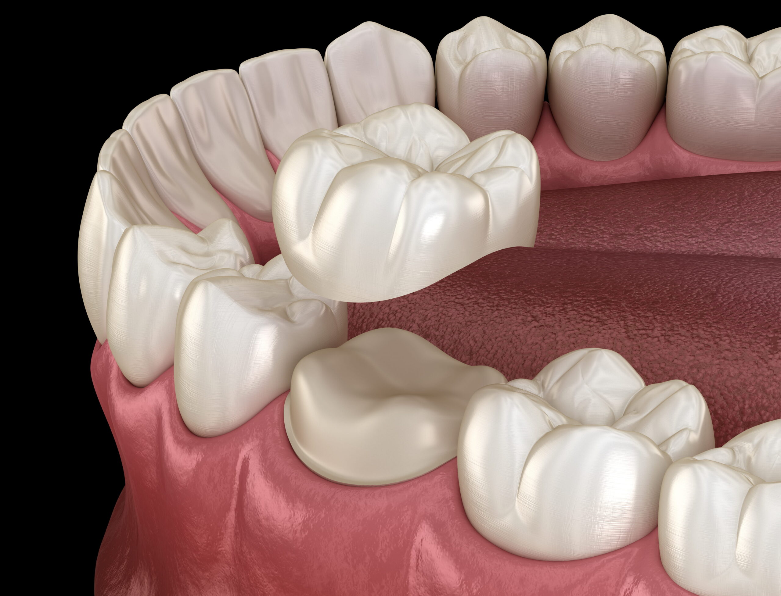 Everything You Need to Know About Dental Crowns