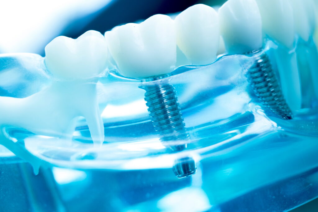 How Long Do Dental Implants Last?