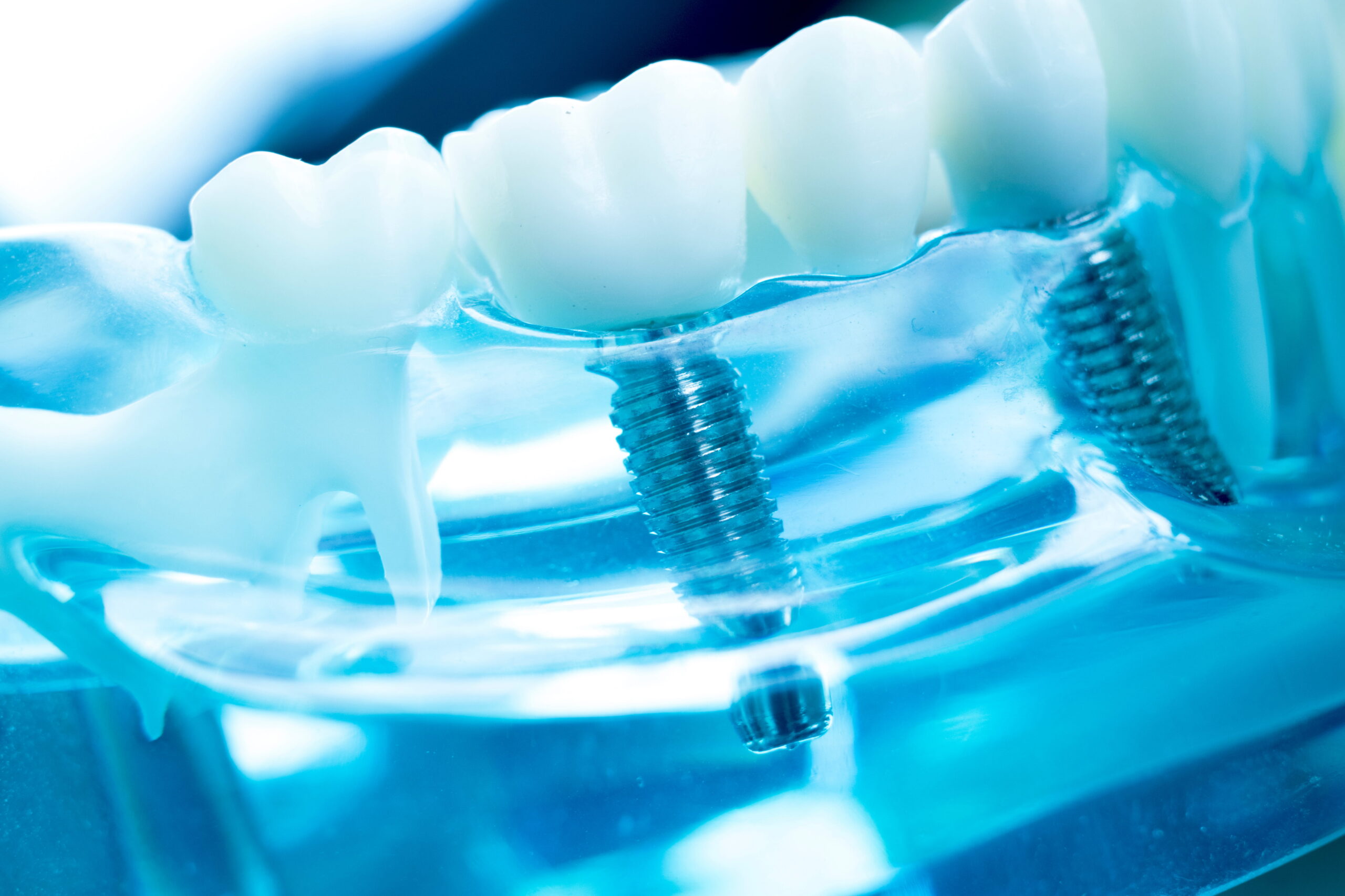 How Long Do Dental Implants Last?