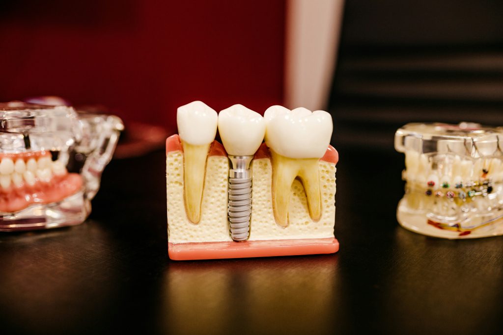 dental implants in Murrieta