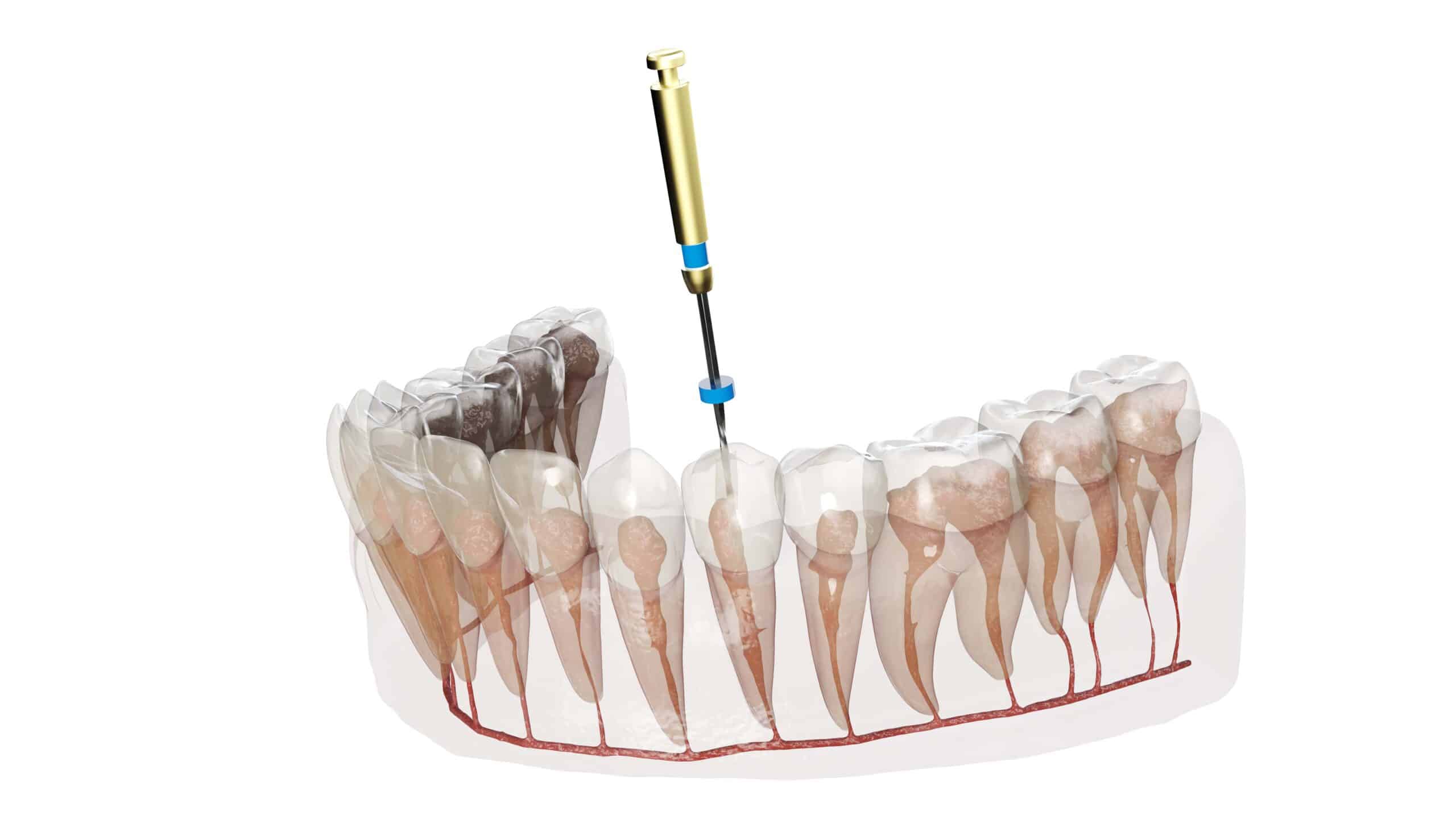 Debunking Common Myths About Root Canal Treatment