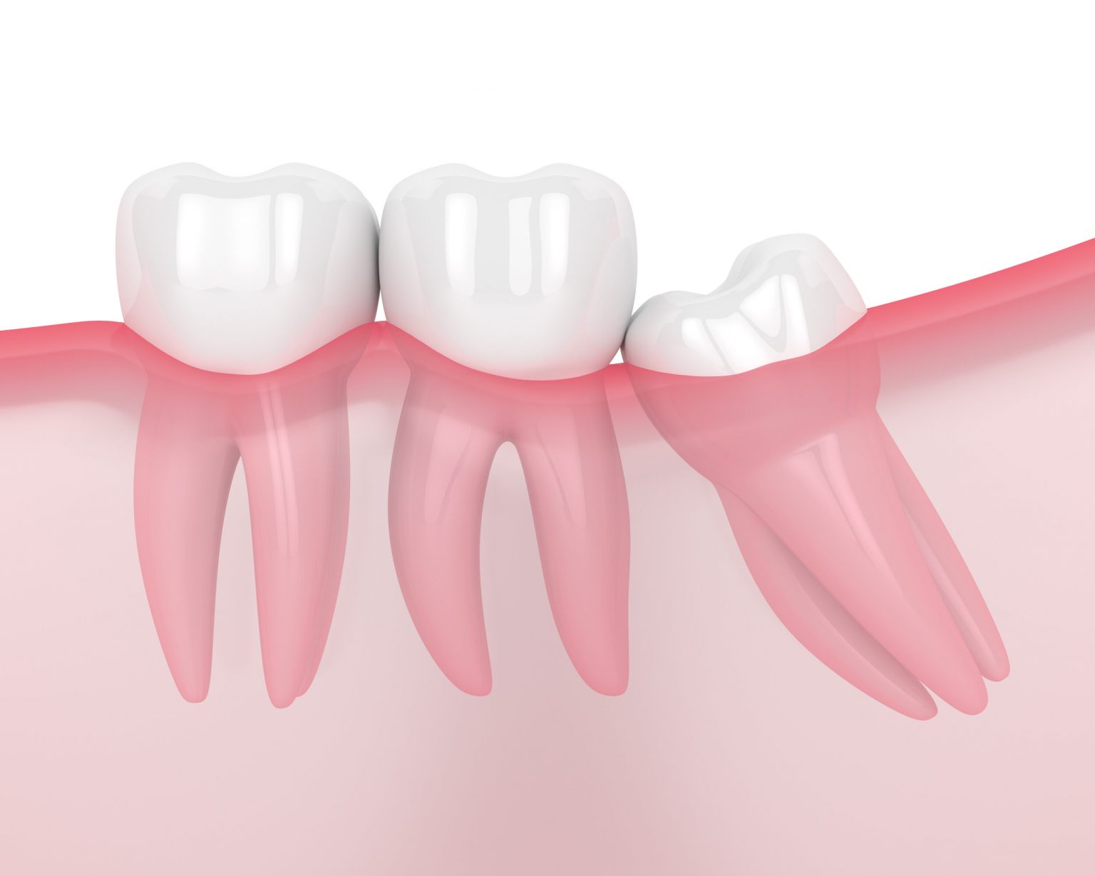 What To Expect When Having Wisdom Teeth Removed